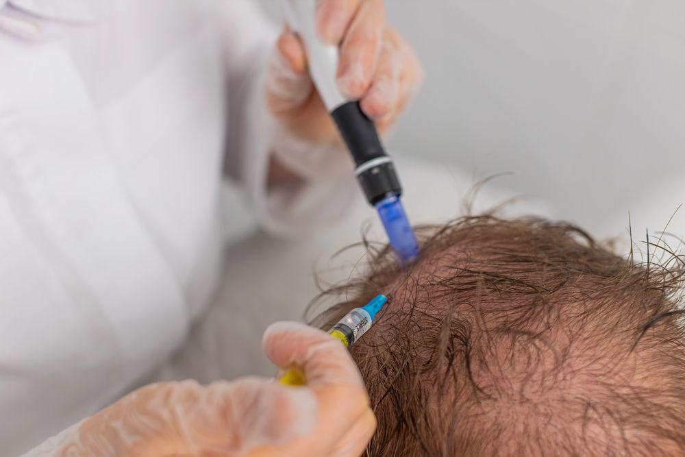 Physician performing PRP hair restoration injection at Evolve Health Saint Cloud FL Physician performing PRP hair restoration injection at Evolve Health Saint Cloud FL