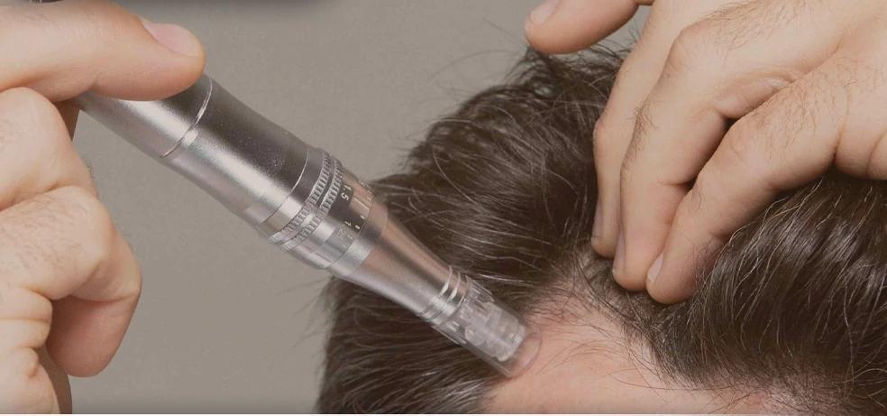 Advanced hair restoration technology at Evolve Health Saint Cloud Florida Advanced hair restoration technology at Evolve Health Saint Cloud Florida