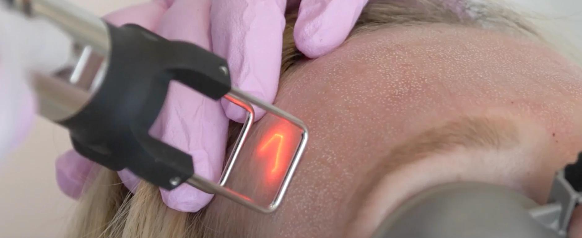 CO2 fractional laser skin resurfacing and Cool Peel treatment at Evolve Health Saint Cloud FL CO2 fractional laser skin resurfacing and Cool Peel treatment at Evolve Health Saint Cloud FL