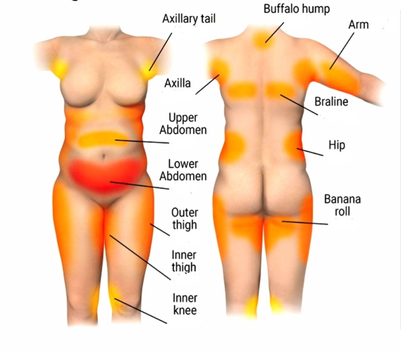 quantum rf areas to treat