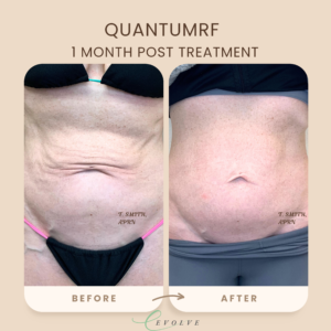 Quantum RF Body Contouring