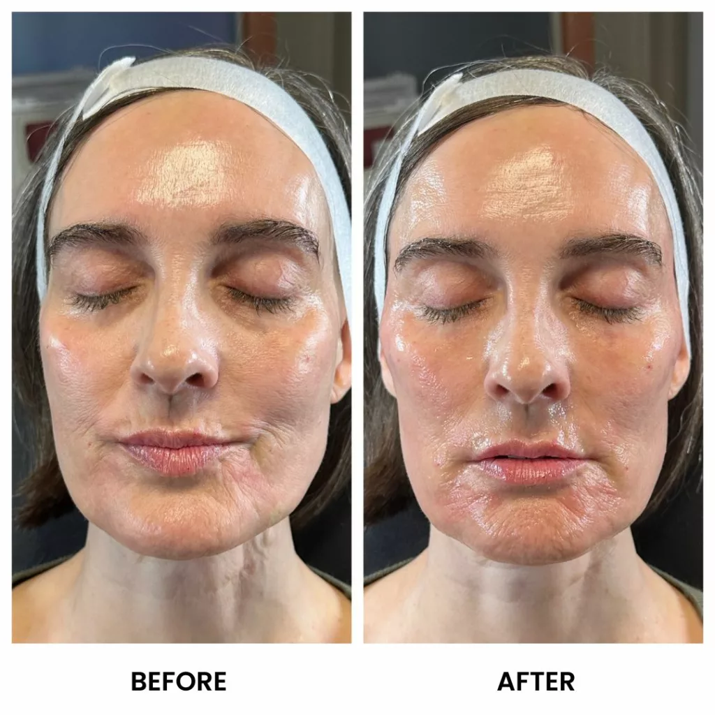 derma prp filler saint cloud lake nona