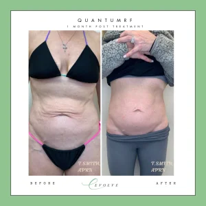 One month post procedure of the stomach Quantum RF before and after image.