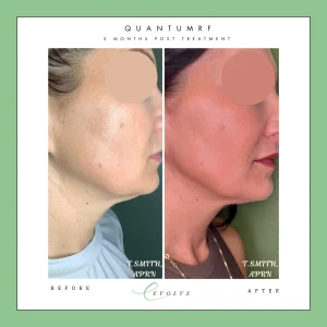 Three month post procedure on the jawline Quantum RF before and after image